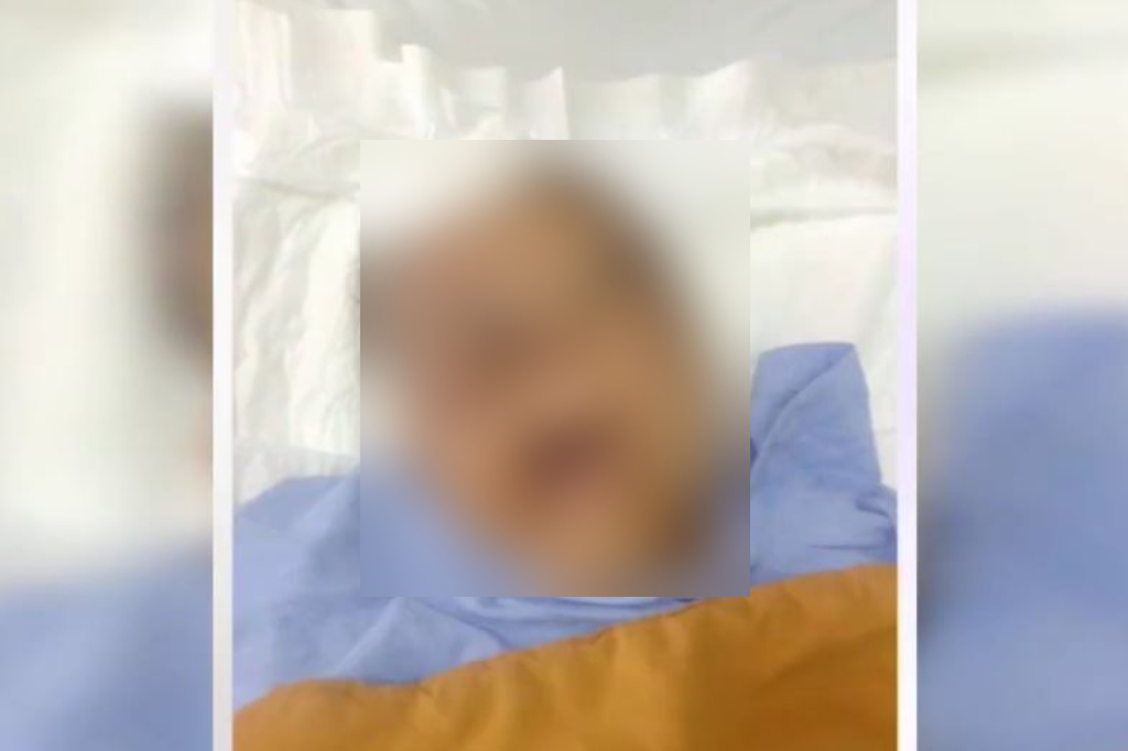 Kondisi Perempuan Dianiaya Pacar 3 Tahun di Bandung, Penuh Luka Tak Terbayangkan