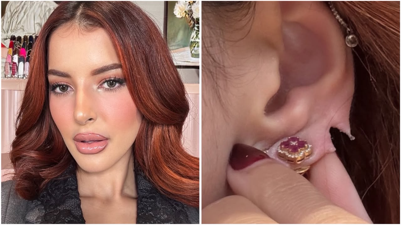 Ngeri Banget! Kuping Tasya Farasya Sobek Terbelah Dua