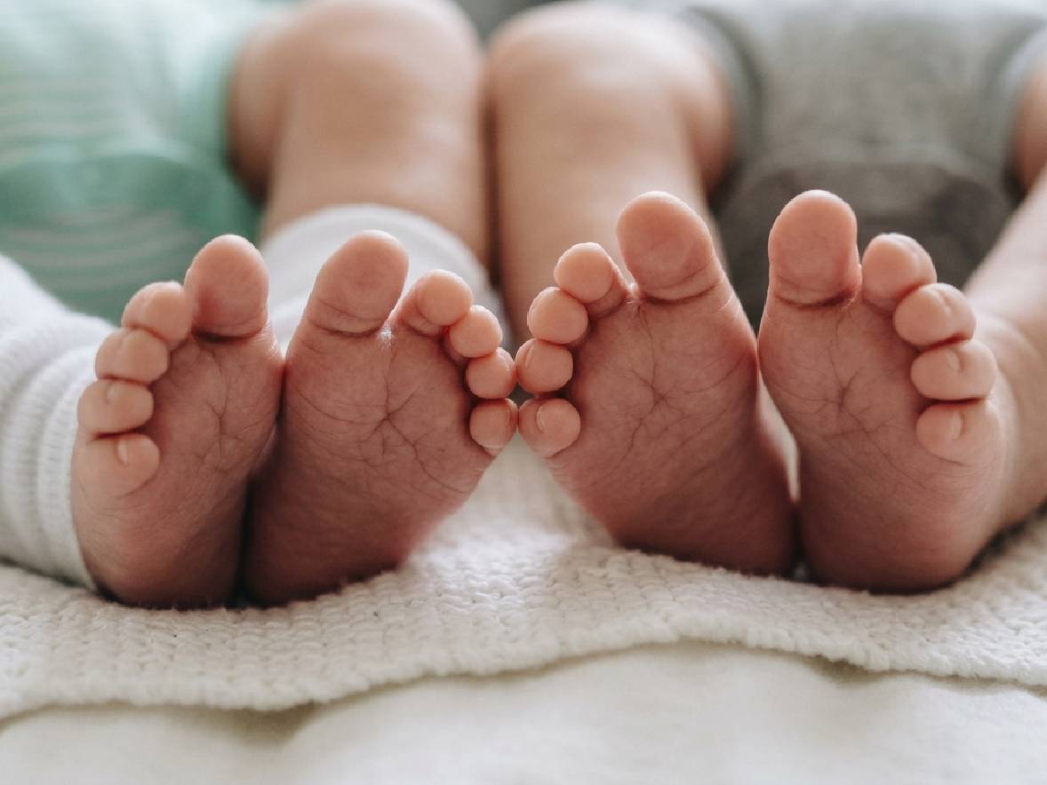 Kondisi Terkini Bayi Kembar Siam yang Dipisahkan di RSCM, Jalani Pemulihan Terpisah