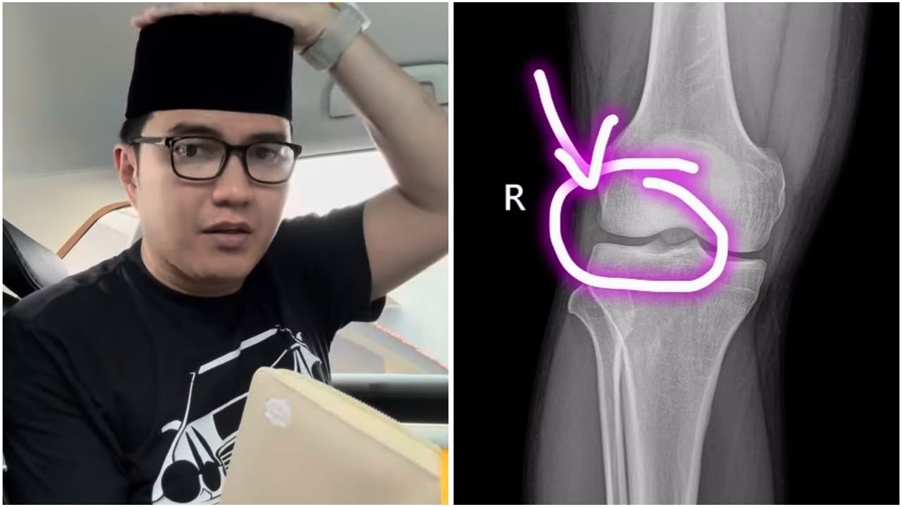 Aldi Taher Kena Pengapuran Tulang, Dengkul Sakit saat Salat