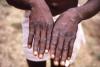 Pertama Kali di Singapura, 1 Orang Kena Penyakit Langka Monkeypox