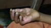 Kejam, Tangan Anak Dibakar Ibu Tiri Hingga Melepuh dan Cacat Permanen