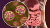 Fakta-Fakta Norovirus, Virus Mematikan Pemicu Infeksi Usus Akut