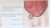Mengenal Hernia Inguinalis, Benarkah Rentan Dialami oleh Bayi Prematur?