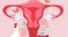Proses Menstruasi pada Wanita, Tahapan, Gejala dan Hormon yang Memengaruhi