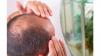 5 Cara Menumbuhkan Rambut di Jidat, Cocok Buat yang Mengalami Kebotakan