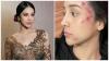 Anya Geraldine Bikin Heboh Usai Unggah Foto Wajah Lebam, Ternyata Gara-Gara Ini