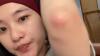 Viral Kisah Perempuan Terkena Ringworm usai Pakai Matras Gym, Imbau Netizen Berhati-hati