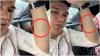 Aldi Taher Operasi Benjolan di Tangan, Ada Kaitannya dengan Riwayat Kanker Limfoma?
