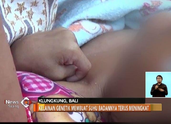 Kelainan Genetik, Bayi di Bali Tidak Punya Pori-pori