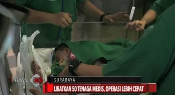 8 Jam Operasi, Bayi Kembar Siam Kelainan Jantung Sukses Dipisahkan