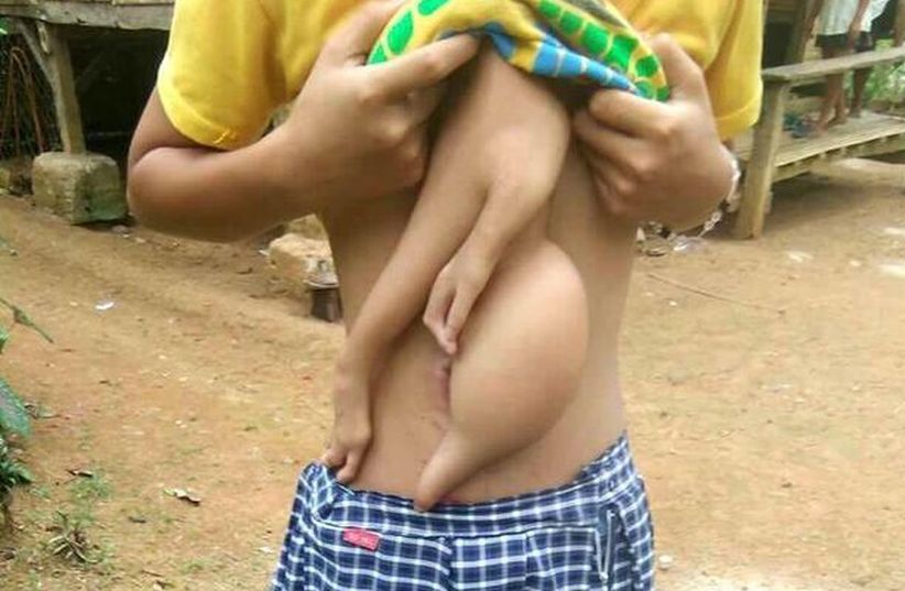 Tangan Menjulur dari Dada Remaja Ini, Ternyata Saudara Kembarnya