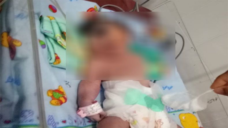 Bayi Perempuan Lahir Bermata Satu Tanpa Hidung Gegerkan Warga Madina