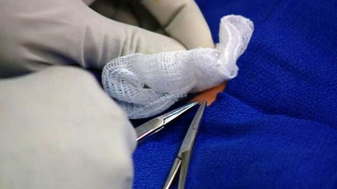 Mengenal Manfaat Sunat untuk Kesehatan, Ternyata Ada Inovasi Aman Tanpa Jarum Suntik 