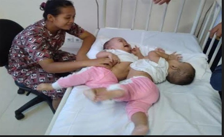Dioperasi 4 Jam, Bayi Kembar Siam Adam dan Malik Sukses Dipisahkan