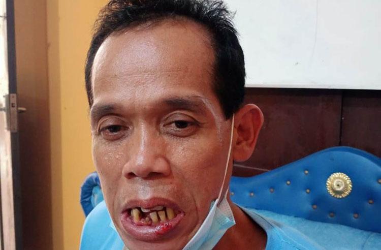 Cemburu Buta, Warga Kulonprogo Main Pukul Akibatkan 3 Gigi Korban Goyang 
