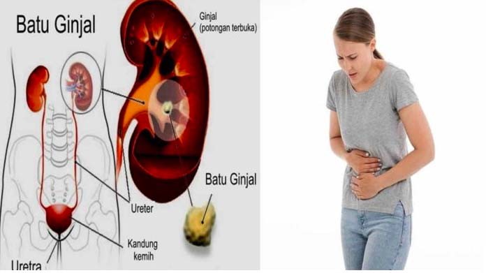 Kenali Gejala dan Mencegah Batu Ginjal, Penyakit yang Diderita Ashanty 