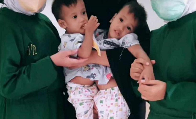Bayi Kembar Dempet Perut di Kotawaringin Barat Akan Dioperasi di RSCM Jakarta