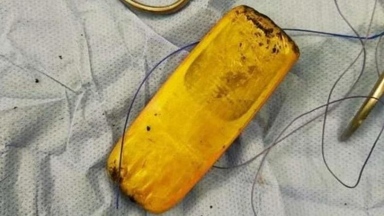Bedah Perut Pasien, Dokter Berhasil Keluarkan Ponsel 