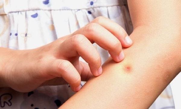 7 Cara Mengobati Bisul Agar Cepat Kempes, Bisa Dilakukan Sendiri di Rumah