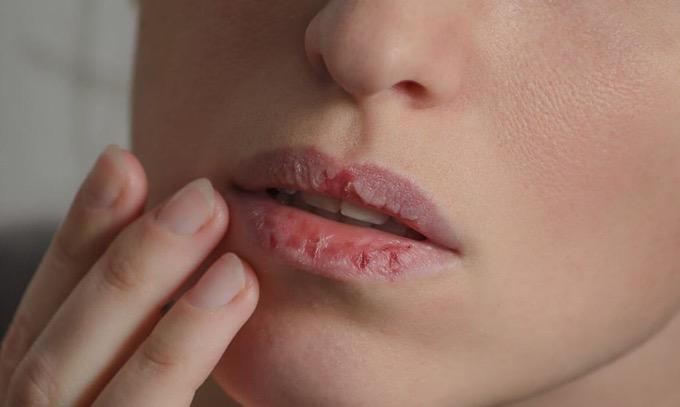 Cara Mengatasi Bibir Pecah saat Puasa, Nomor 3 Sering Tak Disadari Jadi Penyebabnya!