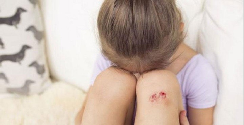 5 Cara Menghilangkan Koreng di Kaki, Dijamin Kulit Kembali Mulus