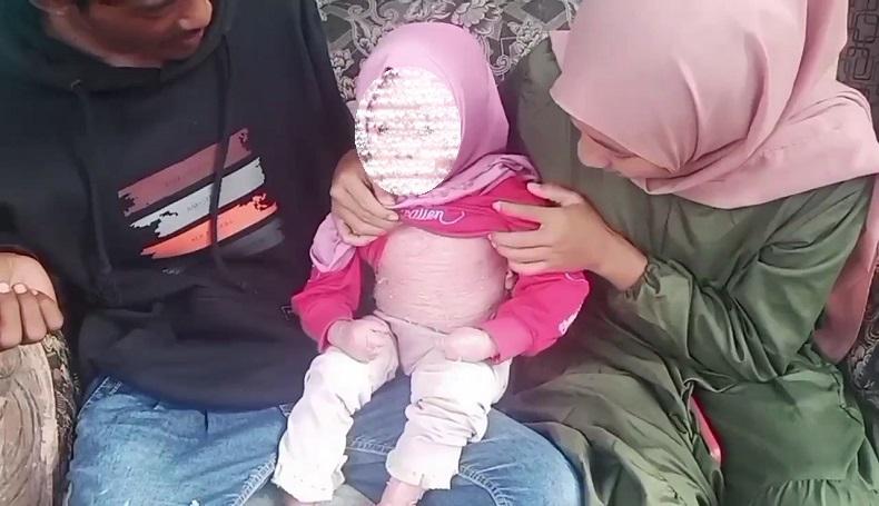 Balita di Subang Idap Penyakit Langka, Tubuh Bersisik Tebal dengan Gatal Luar Biasa