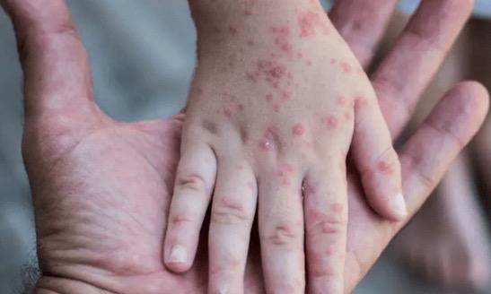 Virus Cacar Monyet, Kenali Penyebab dan Cara Mengatasinya