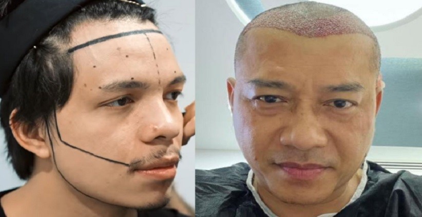 Tips Mengatasi Kebotakan dengan Transplantasi Rambut, Bisa Tumbuh Alami dalam Waktu 6 Bulan 