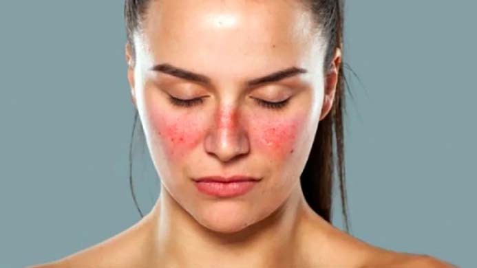 Mengenal Penyakit Lupus, Ini Gejala dan Cara Pengobatannya