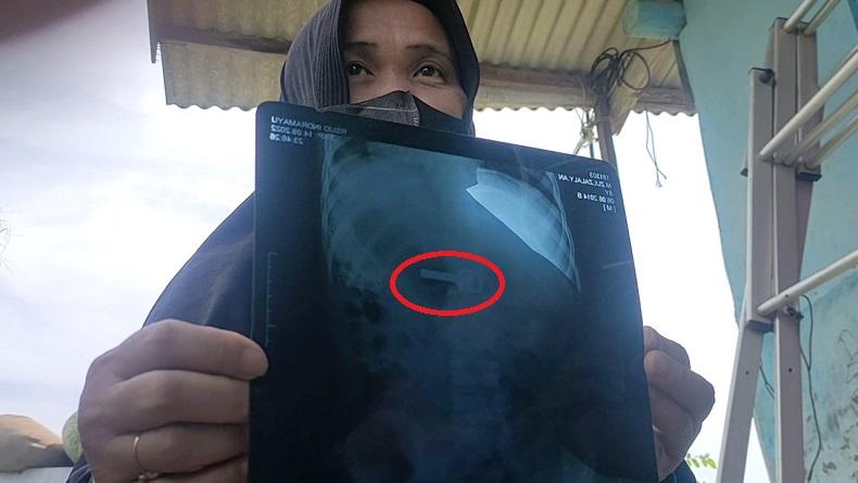 Waduh, Bermain Sambil Tiduran, Bocah di Indramayu Tak Sengaja Telan Anak Kunci