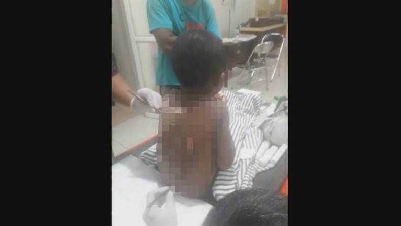 Dituduh Mencuri, Bocah 6 Tahun di Lumajang Disiram Air Panas oleh Orang Tuanya
