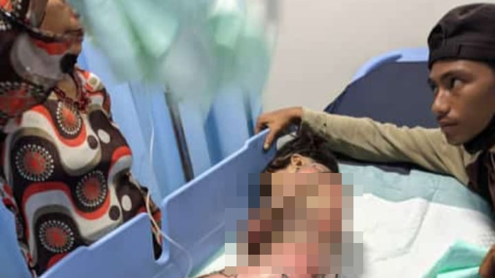 Pilu, Tubuh Bocah 7 Tahun di Lampung Utara Melepuh Tersiram Air Panas 