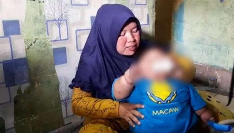 Balita di Bekasi Alami Obesitas, Berat Badan 27 Kg