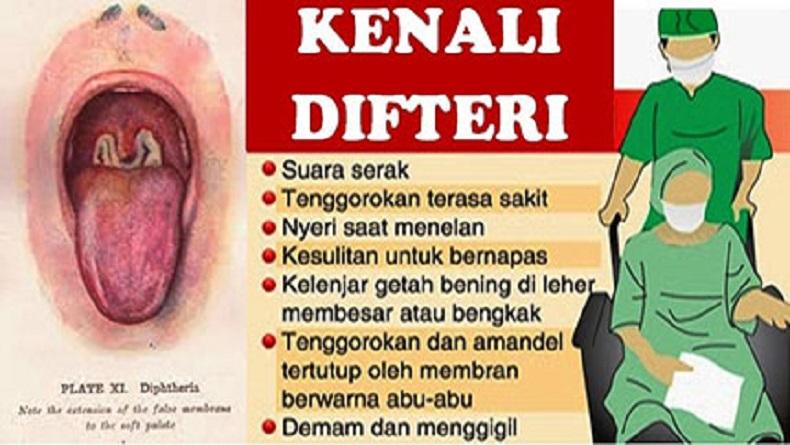 Kasus Difteri Bukan hanya Garut tapi Juga 6 Kota-Kabupaten di Jabar