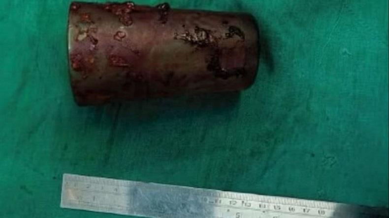 Mabuk, Pria Ini Masukkan Gelas 12 Cm ke Bokong demi Kepuasan Seksual