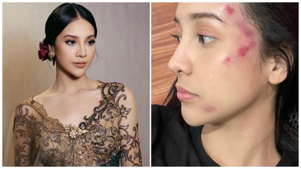 Anya Geraldine Bikin Heboh Usai Unggah Foto Wajah Lebam, Ternyata Gara-Gara Ini