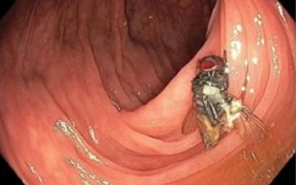 Di Luar Nalar! Dokter Temukan Lalat Utuh dalam Usus Pria Ini, Kok Bisa?
