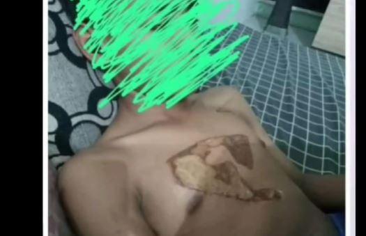 Pelajar MTs di Semarang jadi Korban Bullying Teman Kelas, Dada Disetrika