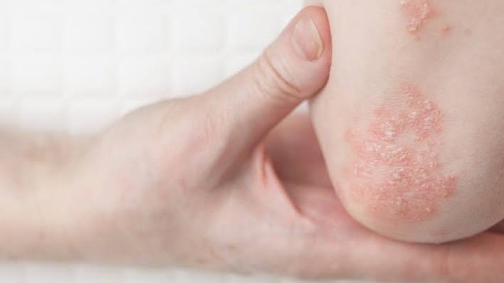 Kulit Sering Gatal dan Meradang Waspada Dermatitis Atopik, Kenali Pencegahannya