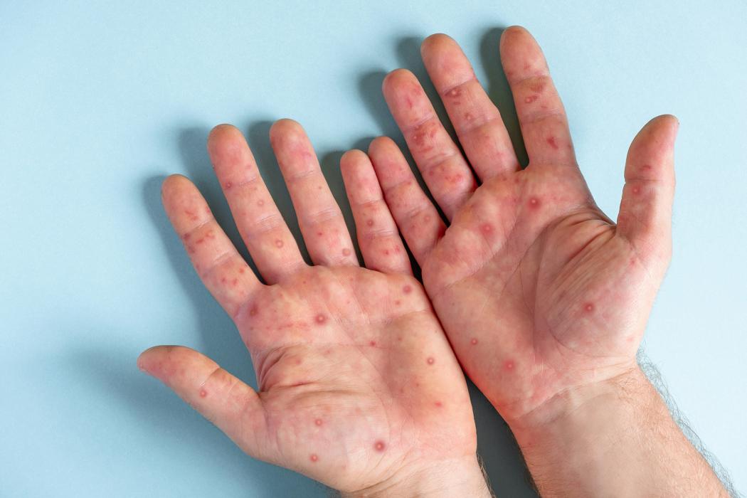 88 Kasus Cacar Monyet Mpox Terkonfirmasi di Indonesia, Jakarta Terbanyak