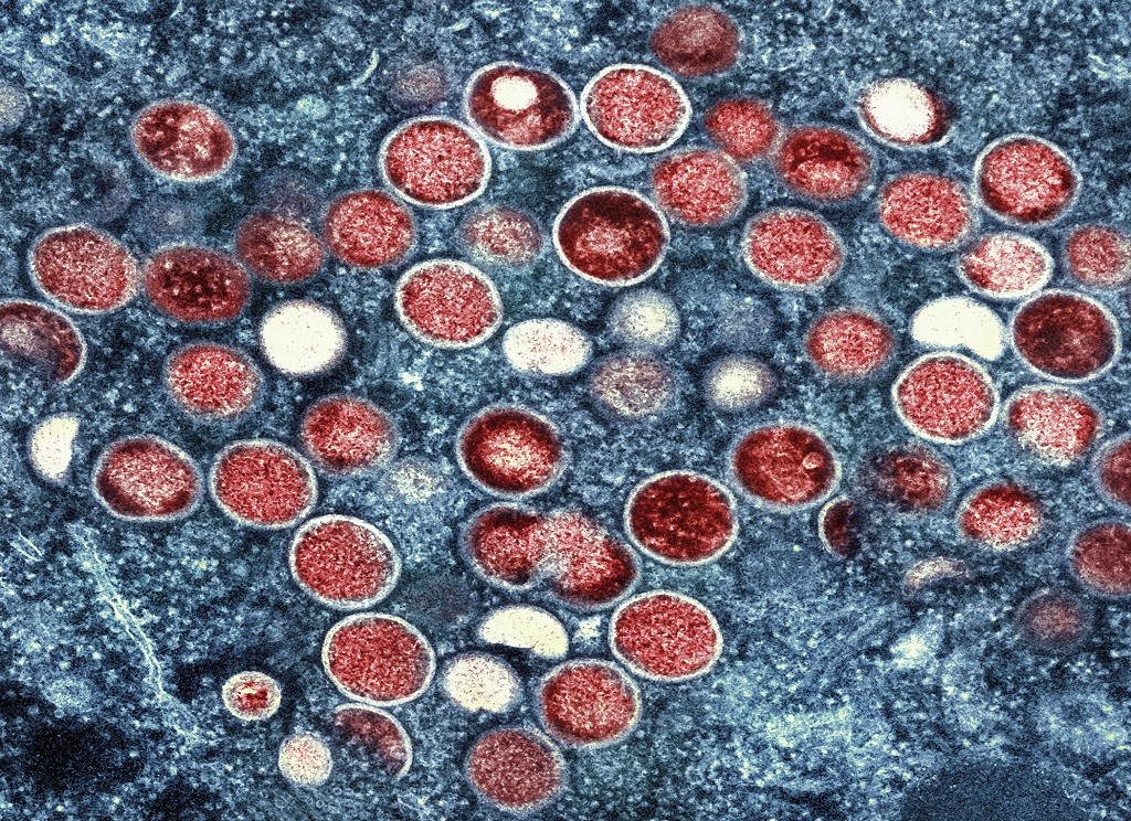 Thailand Laporkan Kasus Pertama Suspek Cacar Monyet Mpox Varian yang Berbahaya