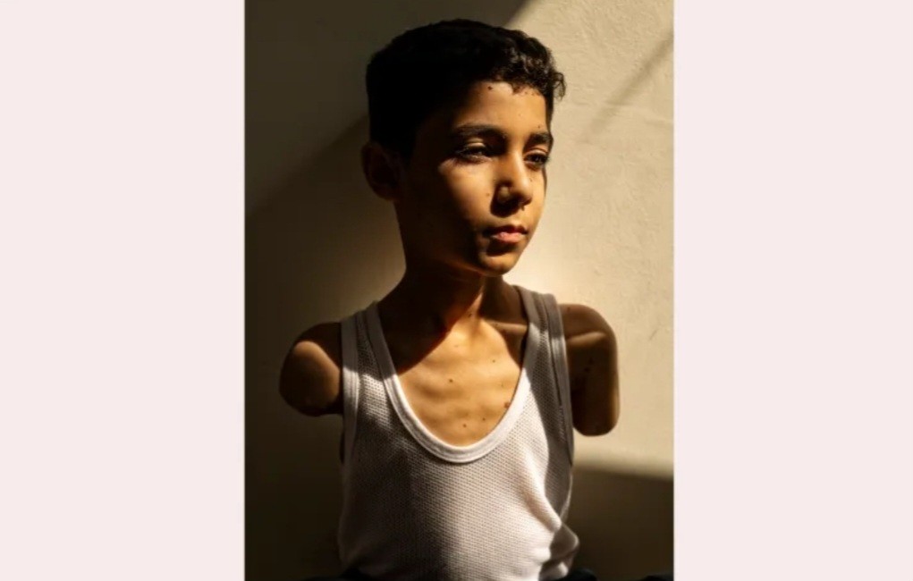 Foto Bocah Gaza Kehilangan 2 Tangan Menangkan Penghargaan World Press Photo 2025