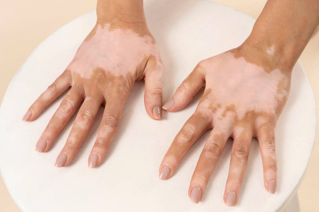Apa Itu Vitiligo? Penyakit Kulit yang Ramai di Medsos