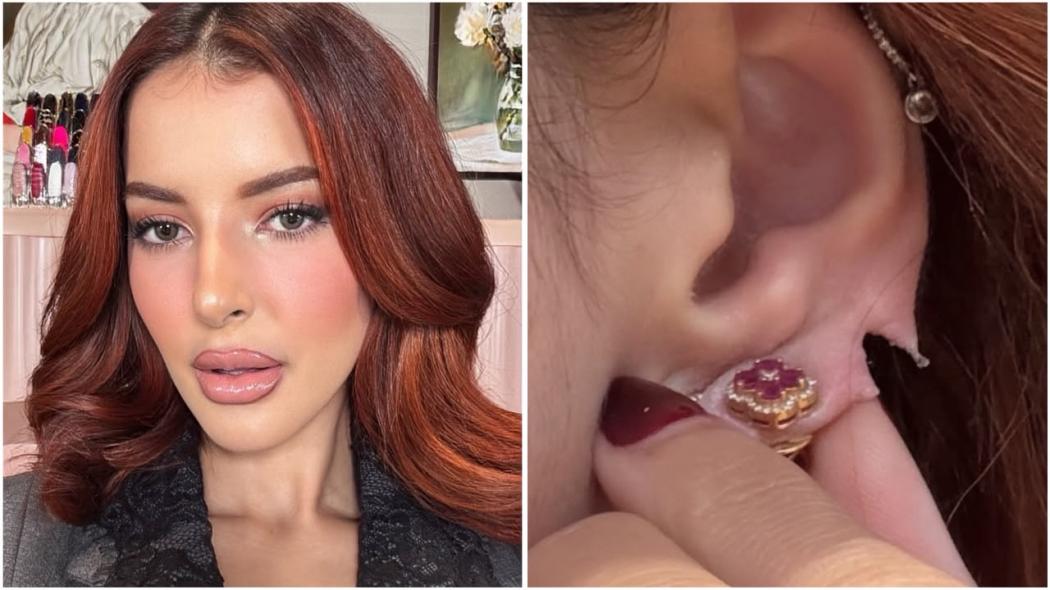 Ngeri Banget! Kuping Tasya Farasya Sobek Terbelah Dua