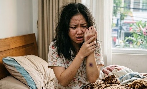 Bangun Tidur Tiba-Tiba Ada Memar Biru? Bukan Dicubit Setan Ini Penyebabnya