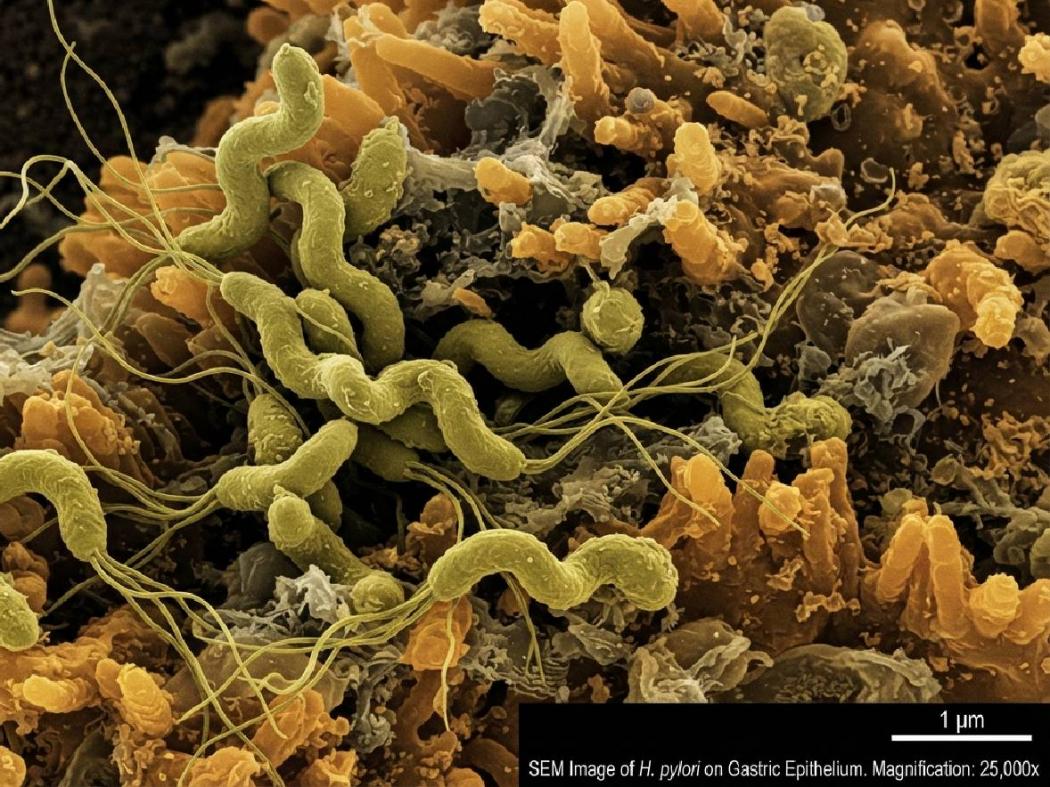 Apa Itu Bakteri H. pylori yang Menginfeksi Sandrinna Michelle? Ini Jawabannya!