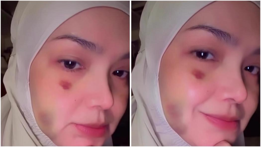 Geger! Wajah Siti Nurhaliza Penuh Lebam dan Biru-Biru, Ada Apa?