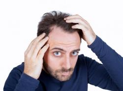 Hair Restoration, Solusi Atasi Kebotakan pada Pria