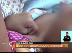 Kelainan Genetik, Bayi di Bali Tidak Punya Pori-pori